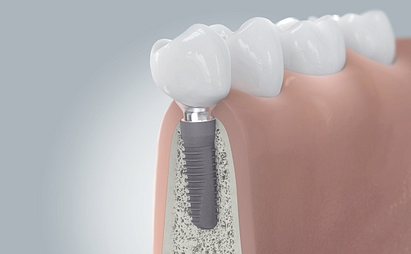 Имплантация